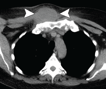 Axial CT showing a chest wall abscess.