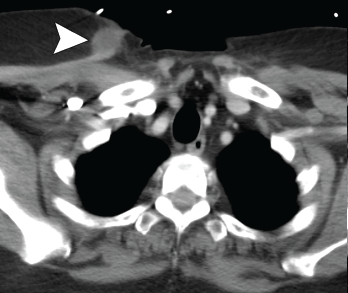 Axial CT showing a second chest wall abscess.