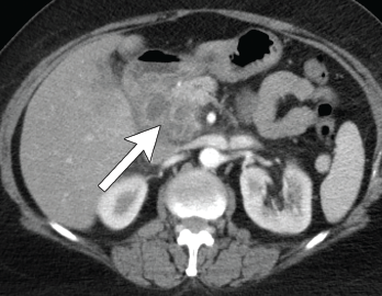 Axial CT showing multilocular abdominal fluid collection. 