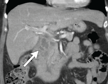 Coronal CT showing multilocular abdominal fluid collection.