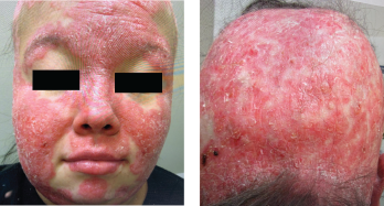 Classic malar butterfly rash of the forehead, chin and malar cheeks. Note the relative sparing of the nasolabial folds. 