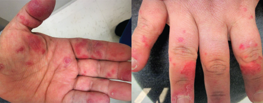 A maculopapular erythematous, violaceous, scaling rash is evident on the dorsal and palmar surfaces of both hands. 