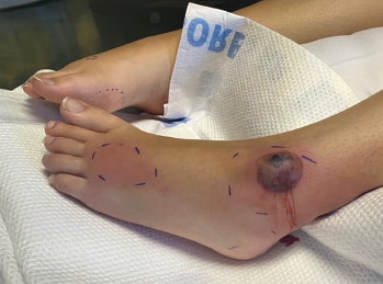 At her initial evaluation, the patient presented with a bullous lesion on her left foot.