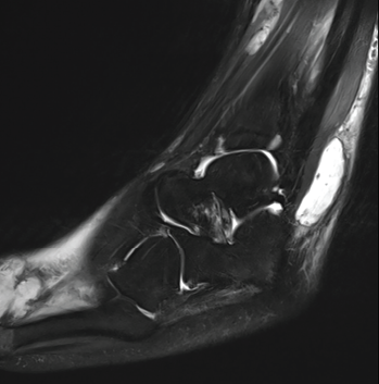 This MRI of the patient’s left ankle (sagittal view) demonstrates a T2 hyperintense complex fluid collection within the posterolateral subcutaneous tissues overlying and coursing along the peroneus tendon and muscles. The collection measures 3.0x1.2x3.8 cm. This image also partly demonstrates a lobulated cystic-appearing fluid collection within the dorsal soft tissues of the forefoot.