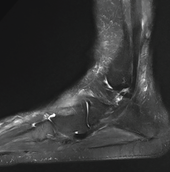 A later MRI demonstrates resolution of previously seen fluid collections after treatment with corticosteroids.