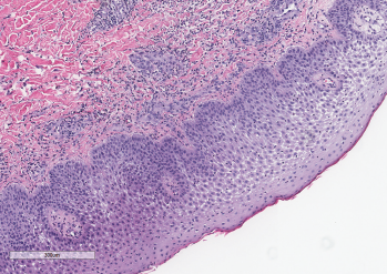 A punch biopsy demonstrated subepidermal edema overlying a dense neutrophilic inflammatory infiltrate in the dermis and epidermis. Courtesy Sandra Haddad, MD