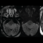 Case Report: Dermato-Neuro Syndrome Recurrence after a Viral Infection