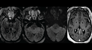Case Report: Dermato-Neuro Syndrome Recurrence after a Viral Infection