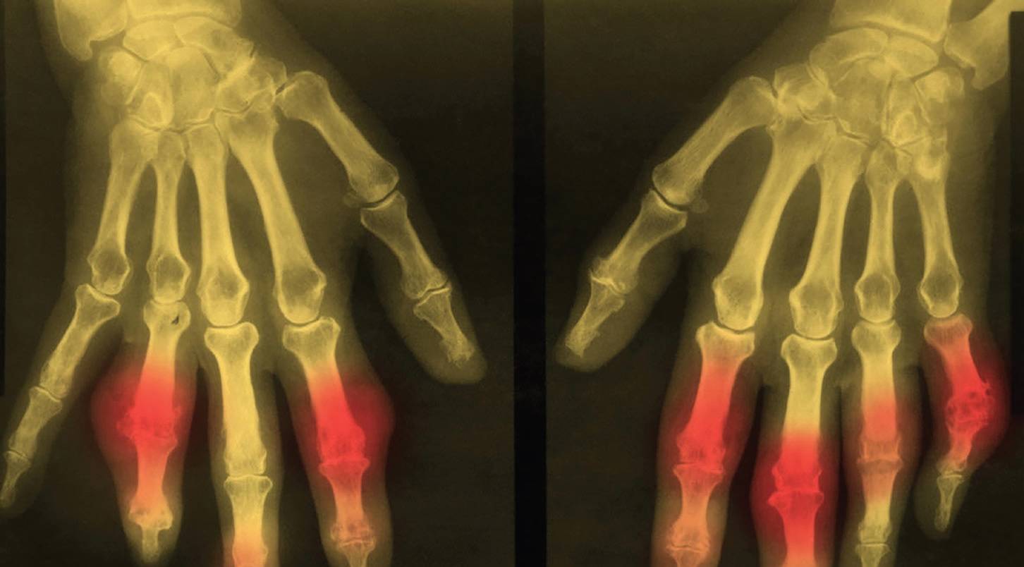 Imaging Modalities in Gout: How to Use them in Clinical Practice - The ...