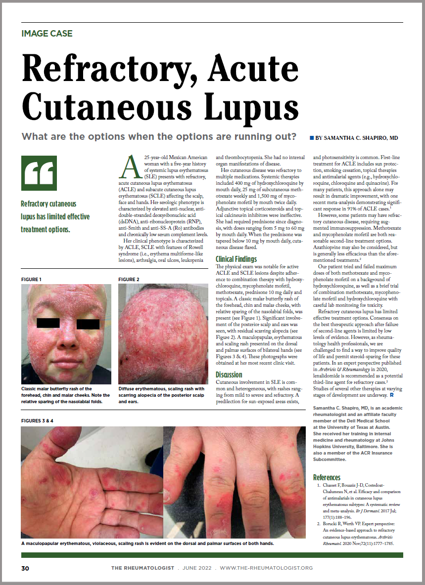patient case study lupus