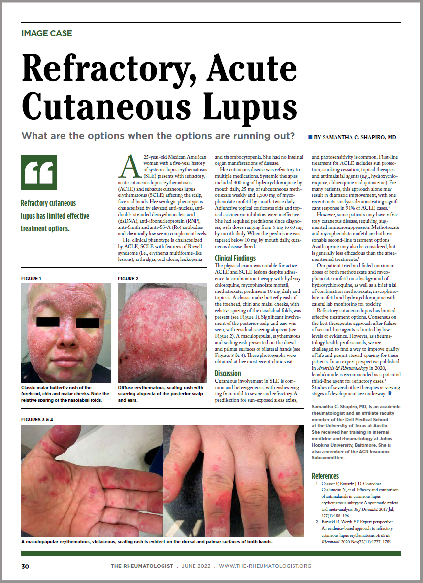 Dermatologist, Rheumatologist Discuss Refractory Cutaneous Lupus Case