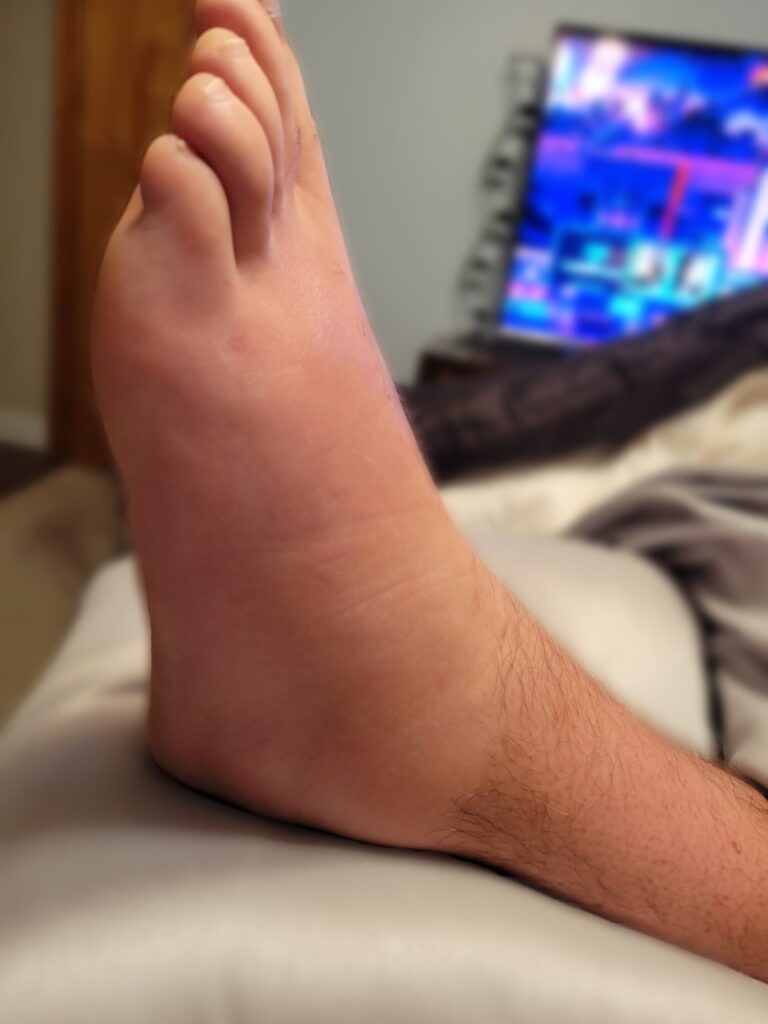 Case Report Migratory Polyarthritis as the Presenting Symptom of GPA