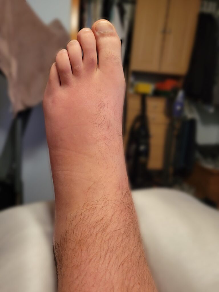 Case Report Migratory Polyarthritis as the Presenting Symptom of GPA