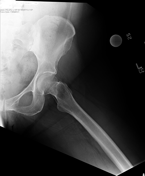 Physical Therapy in Middleton for Hip - Trochanteric Bursitis Surgery