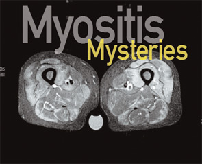 FIGURE 1:  Short tau inversion recovery (STIR) image of proximal thighs showing increased signal intensity interpreted as edema in a patient with active polymyositis.