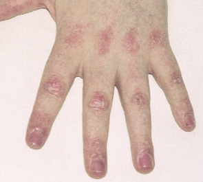 FIGURE 2: Gottron’s papules. Raised purple-red areas on the dorsal aspect of metacarpal and interphalangeal joints pathognomonic for dermatomyositis.