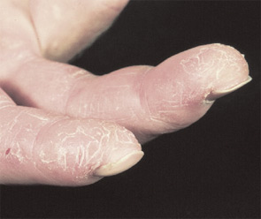 FIGURE 3: Mechanics hands. Roughening of the radial sides of the fingers seen in patients with anti–aminoacyl-tRNA synthetase (anti–Jo-1) autoantibodies.