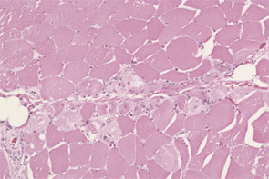 FIGURE 4: Hematoxlyn and eosin (H&E) and Gomori trichrome stains of muscle: A) H&E stain demonstrating perivascular and perifascicular inflammation characteristic of DM;