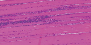 FIGURE 4: Hematoxlyn and eosin (H&E) and Gomori trichrome stains of muscle: B) H&E stain demonstrating foci of endomysial infiltrates by mononuclear cells characteristic of PM;