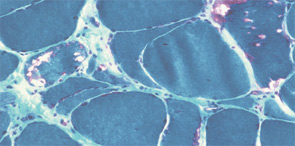 FIGURE 4: Hematoxlyn and eosin (H&E) and Gomori trichrome stains of muscle: C) Gomori trichrome stain demonstrating red-rimmed vacuoles characteristic of IBM.