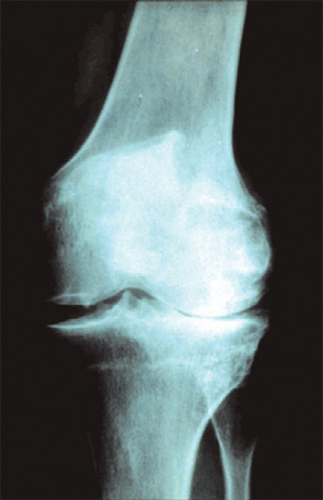 FIGURE 1: Standing X-ray of OA of the knee. Joint-space narrowing and osteophytes are hallmark pathologic changes.