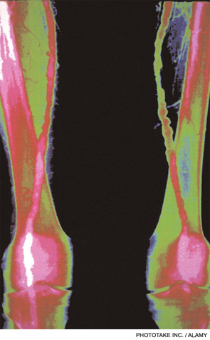 Arteriogram showing arteritis in the lower limbs.