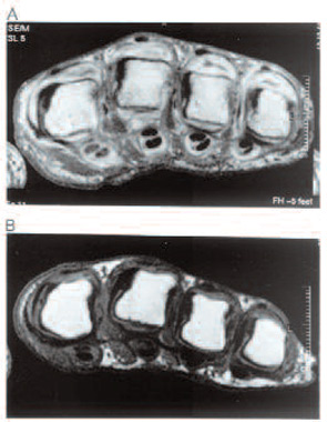FIGURE 1: Axial sequences of rheumatoid arthritis MCP joints from the same subject before (A) and after (B) treatment with an anti-TNF therapy. (Both images are post-contrast.)