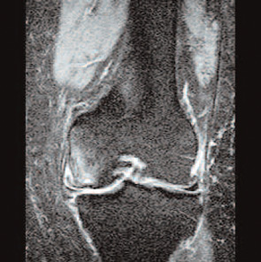 FIGURE 2: STIR coronal image of an osteoarthritic knee demonstrating multiple pathologies, especially in the medial compartment where meniscal damage and extrusion, bone marrow edema (femoral condyle), and loss of hyaline cartilage are present.