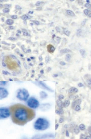 Figure 3: Immunostaining of IL-17A positive cells in the RA synovium. The two sections at low magnification show isolated IL-17A–positive cells in the synovitis infiltrate. The close view shows the plasma cell–like appearance of a IL-17A–positive cell.
