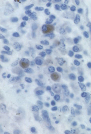 Figure 3: Immunostaining of IL-17A positive cells in the RA synovium. The two sections at low magnification show isolated IL-17A–positive cells in the synovitis infiltrate. The close view shows the plasma cell–like appearance of a IL-17A–positive cell.