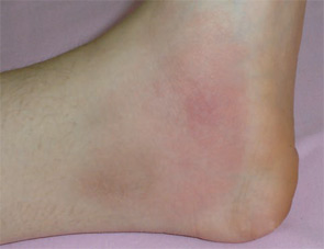 FIGURE 1: Erysipelas-like erythema, the characteristic skin lesion of FMF.