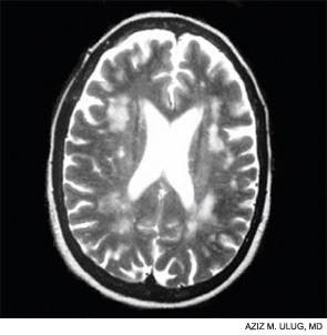 Figure 1: Hyperintense lesions as seen on T2 imaging.