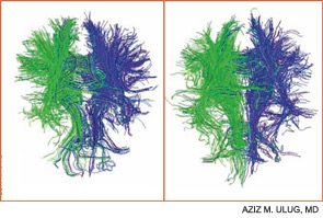 Figure 2A: DTI demonstrating white track connections in a normal brain (LEFT). Figure 2B: DTI in a brain from a patient with lupus.  The quantity of tracks is less than that in a normal person (RIGHT).