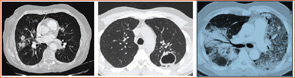 Figure 2: Pulmonary involvement can have many radiographic presentations, including single or bilateral nodules or infiltrates, cavities, or ground glass infiltrates suggestive of alveolar hemorrhage
