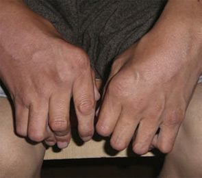 Tibetans with rheumatoid arthritis.