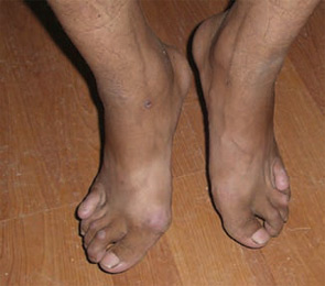 Tibetans with rheumatoid arthritis.