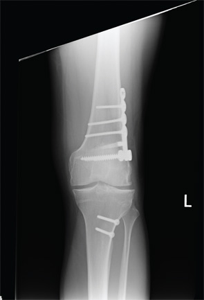 Postoperative radiograph demonstrating a healed distal femoral osteotomy