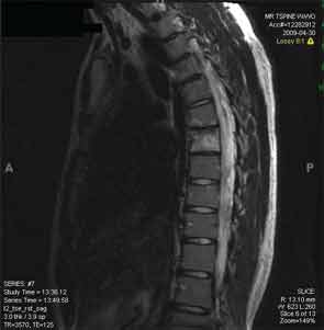 Increased uptake in T7 seen in Patient 1; T2-weighted MRI image.