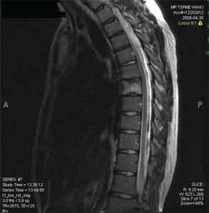 Improvement in the T7 lesion in Patient 1 after infliximab treatment; T2- weighted MRI image.