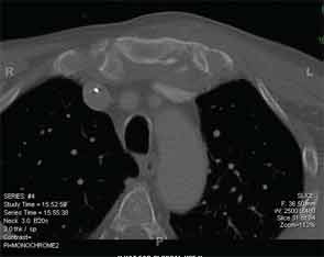 Lesioni erosive nell'area sternoclavicolare del paziente 3; tomografia computerizzata.  La coltura su un campione ottenuto in chirurgia era negativa.