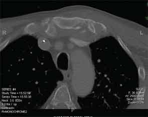 Erosive lesions in the sternoclavicular area of Patient 3; computed tomography. Culture on a specimen obtained at surgery was negative.