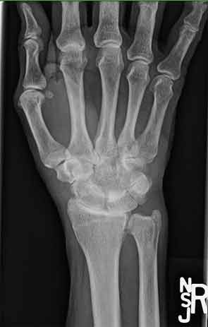 Intercarpal narrowing on wrist radiograph of Patient 3