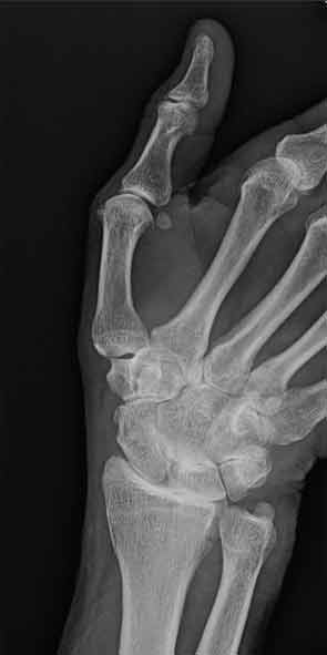 Intercarpal narrowing on wrist radiograph of Patient 3