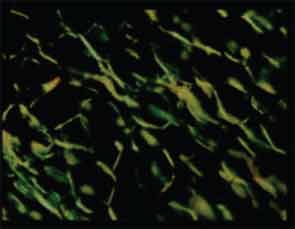 Amyloid deposits stained with Congo red display an apple-green birefringence