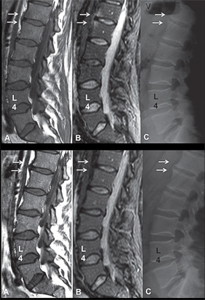 MRI and radiography of the lumbar spine before (A–C) and one year after initiation of TNFα inhibitor therapy