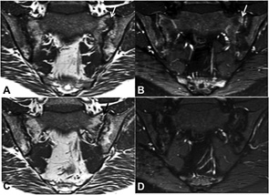 MRI scan of the sacroiliac joints of another patient initiating TNFα inhibitor