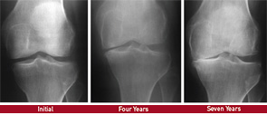 This image shows progressive loss of joint space in the medial tibiofemoral compartment of the left knee in a patient with osteoarthritis.