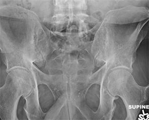 Bilateral sacroiliac joint posteroanterior radiograph obtained at the time of the current presentation.