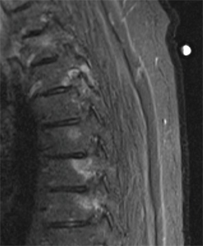 Sagittal STIR image from a thoracic spine MR, obtained two years prior to the current presentation. STIR sequences are fat-suppressed, water-sensitive images, useful for detecting bone marrow and soft tissue edema.