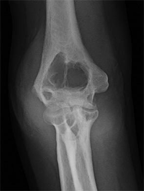 Figure 1: Right elbow anteroposterior radiograph